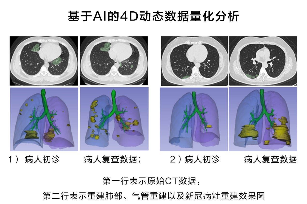 华为云推出新冠肺炎AI 辅助诊断服务CT 量化结果秒级输出-华为云
