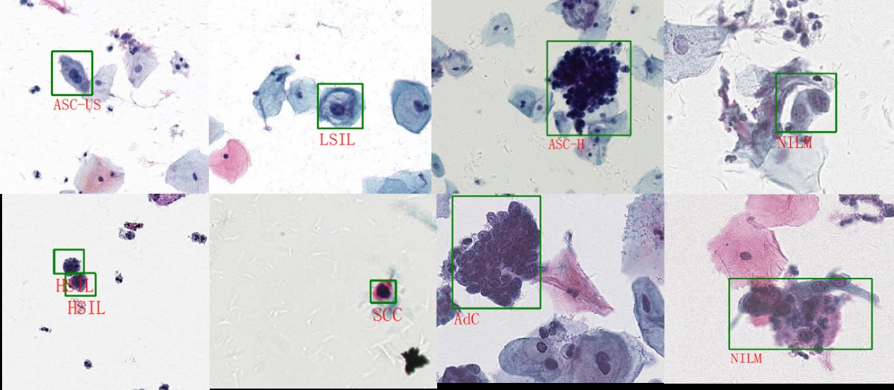 业界最大规模宫颈癌细胞公开数据集标注示例效果图